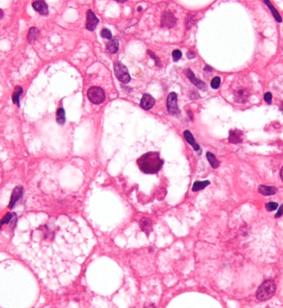 alcohol-associated liver disease